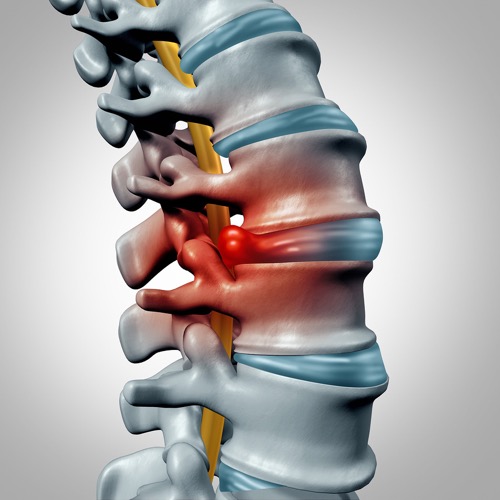Model of lumbar spinal disc herniation